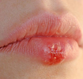 4 effective home remedies for herpes