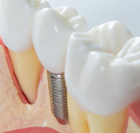 4 practical tips to maintain dental implants for seniors