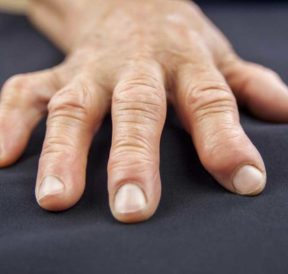 5 Causes of Swollen Fingers