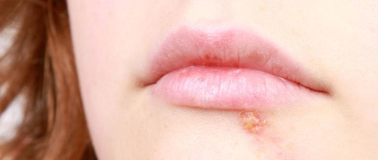 5 useful home remedies to get relief from cold sores
