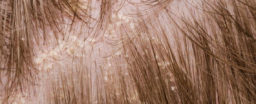A brief overview of scalp psoriasis