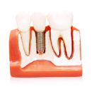 All you need to know about permanent dentures