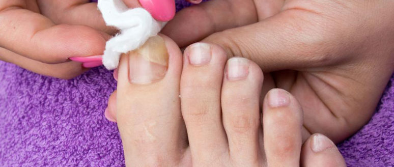 Home remedies for toe nail fungus