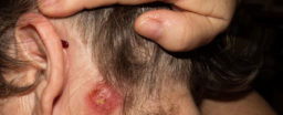 How can you spot the signs of staph infection