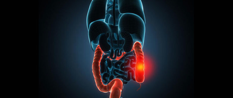 Popular treatments for irritable bowel syndrome