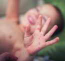 Prevention Tips for Hand, Foot, and Mouth Disease