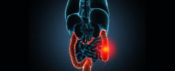 Signs and symptoms of colitis