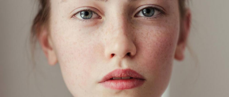 Simple home remedies for freckles