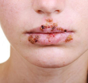 Tips to manage herpes outbreak