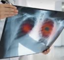 Understanding the Various Pulmonary Fibrosis Treatment Methods