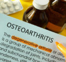 What are the treatment options for managing osteoarthritis
