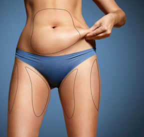 What is coolsculpting fat freezing?